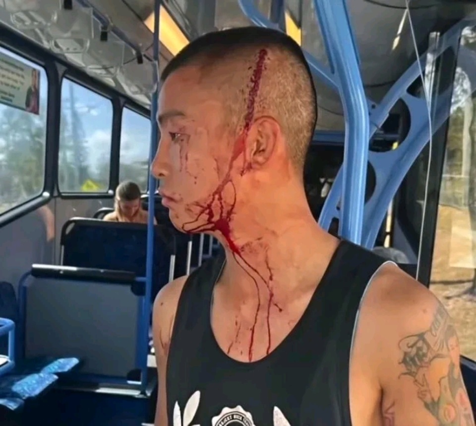 他脑出血 他脑出血